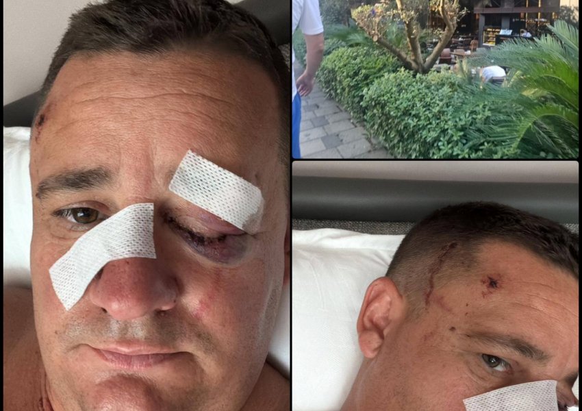 Dhuna mes biznesmenëve në Tiranë/ Dalin fotot e Laert Kasajt nga spitali, me hematoma dhe sy të nxirë