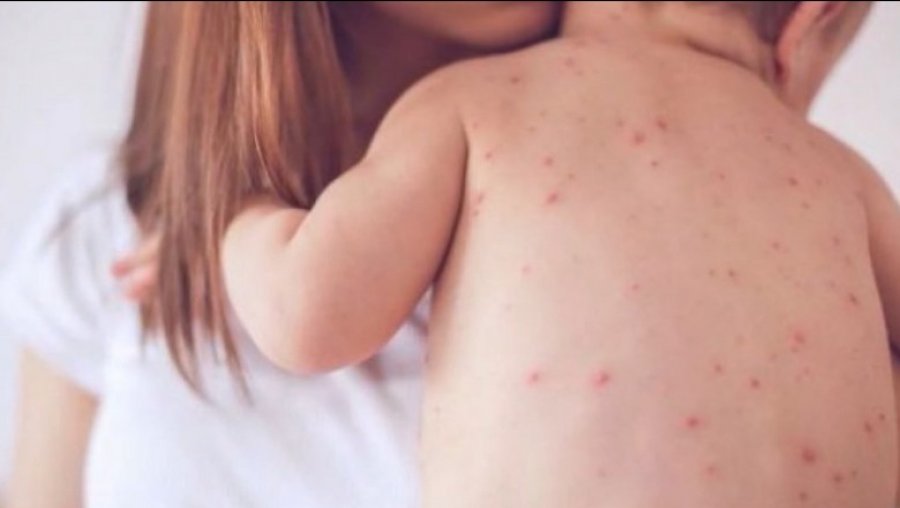 Fruthi, apel për vaksinim/ Në 3 muaj preken 12 fëmijë, shumica të pavaksinuar