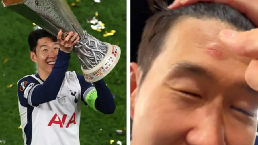 Son lëndohet në ballë nga trofeu i Europa League