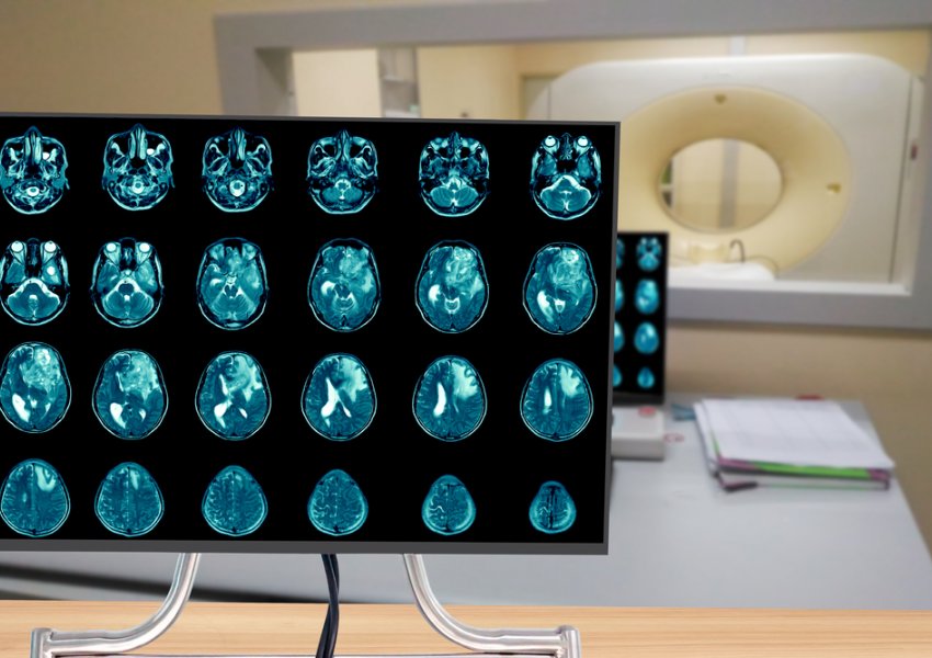 Glioblastoma, pozicioni i qelizave tumorale zbulon agresivitetin e tij