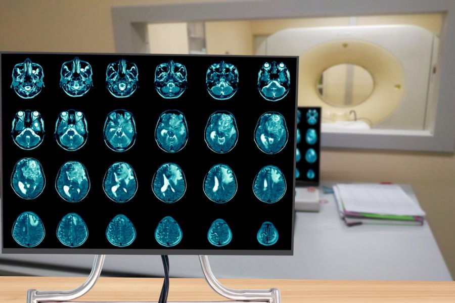 Glioblastoma, pozicioni i qelizave tumorale zbulon agresivitetin e tij
