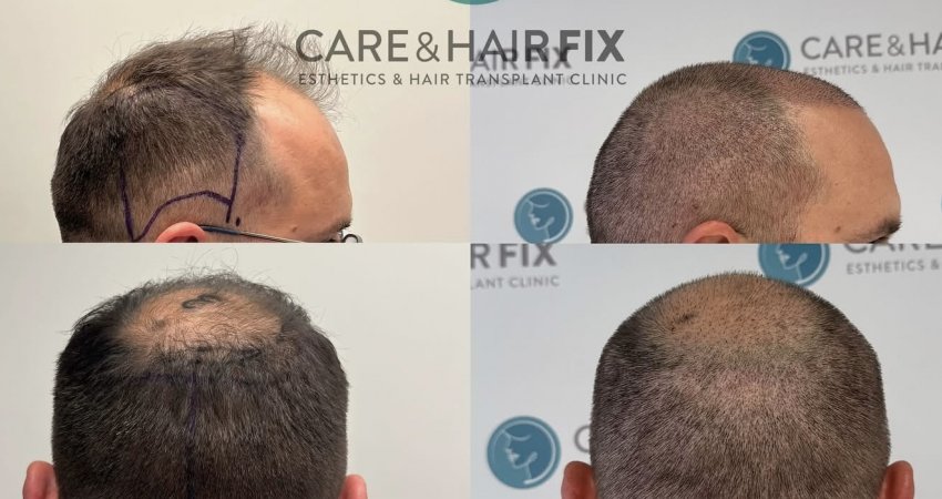 Revolucioni ROBOTIC DHI në Prishtinë – vetëm te Care & Hair Fix