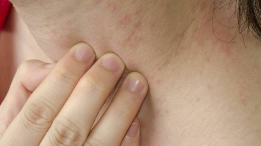5 ushqimet që mund të shkaktojnë alergji, madje edhe vdekjeprurëse!