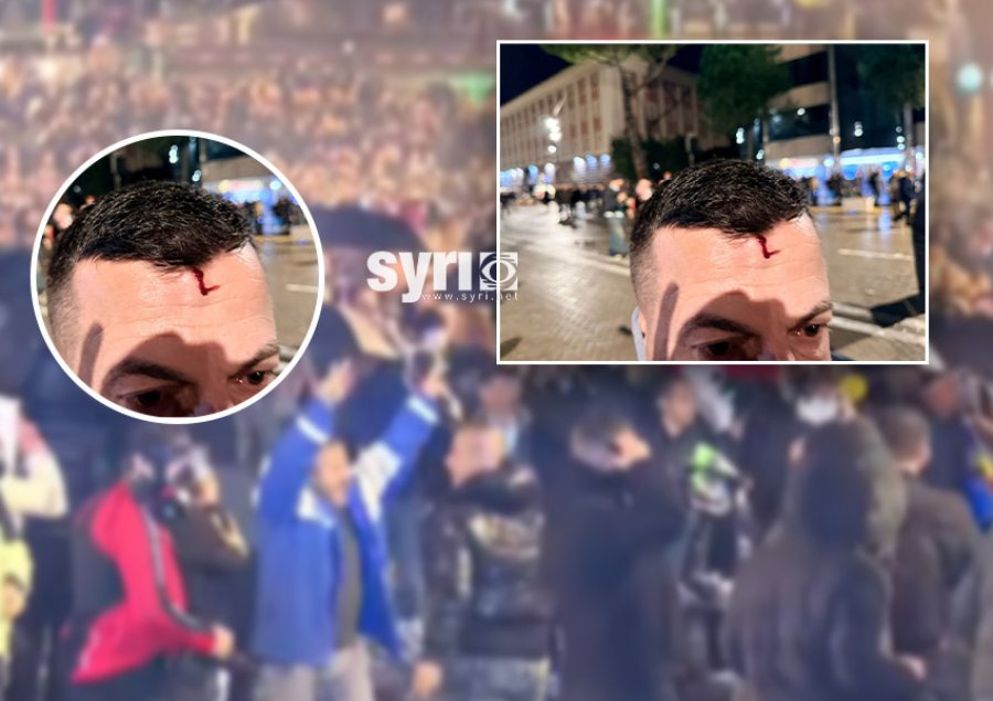 Në këmbë kundër narkoshtetit/ Policia gjakos protestuesin në kokë