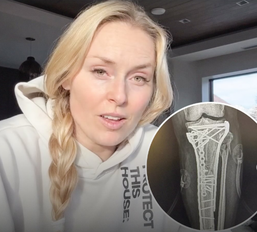 Rrezikoi t’i pritej këmba, Lindsey Vonn del nga spitali dhe tregon mes lotësh ‘dy javët e tmerrit’ (fotot)
