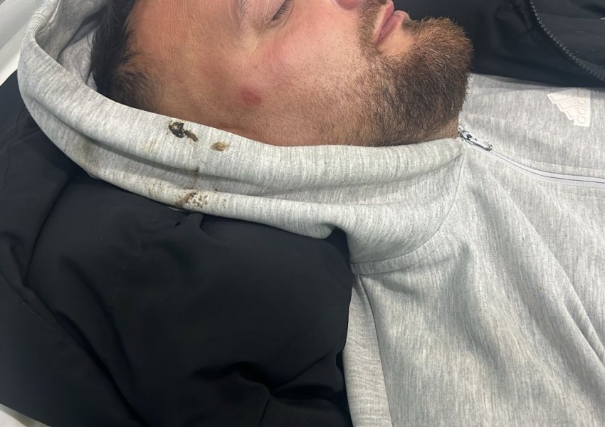 Denoncimi/ U dhunua nga policia pas protestës së PD-së në Tiranë, i riu në urgjencën e spitalit të Beratit