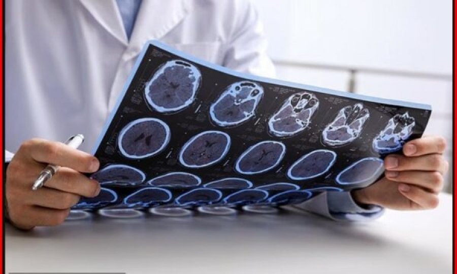 Zbulim i ri për sklerozën multiple: AI ndihmon në identifikimin e lezioneve të fshehura në tru