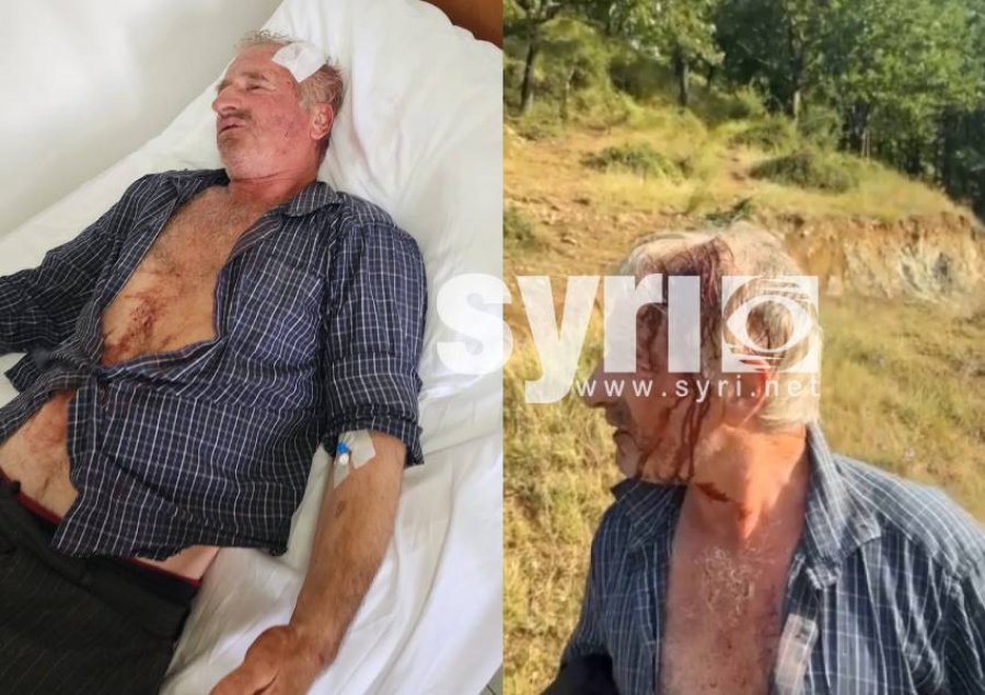 FOTO-EMRI/ Sherr mes fqinjëve në Tropojë, dhunohet 60-vjeçari, përfundon te Trauma në Tiranë
