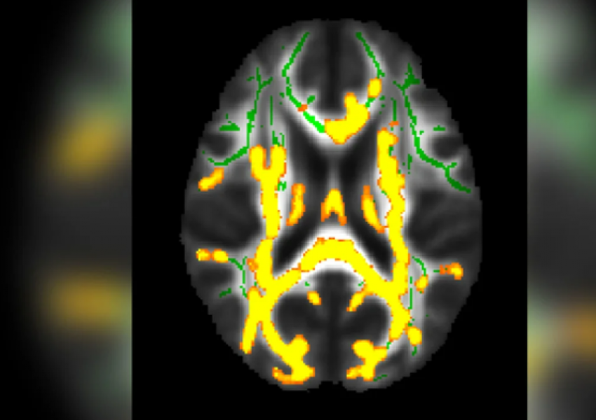 Dhjami i fshehur i barkut mund të jetë tregues i Alzheimer, tregon studimi